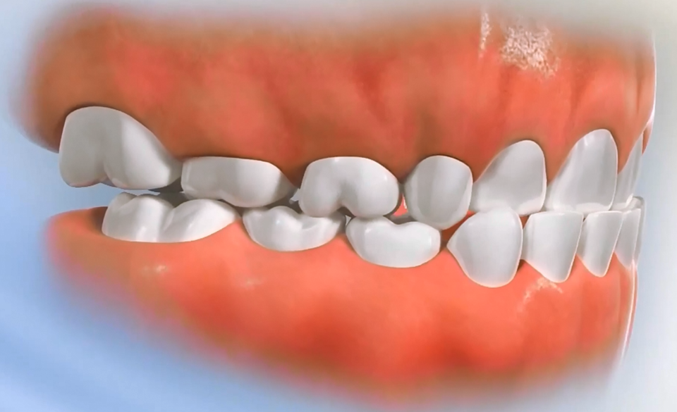 anterior crossbite